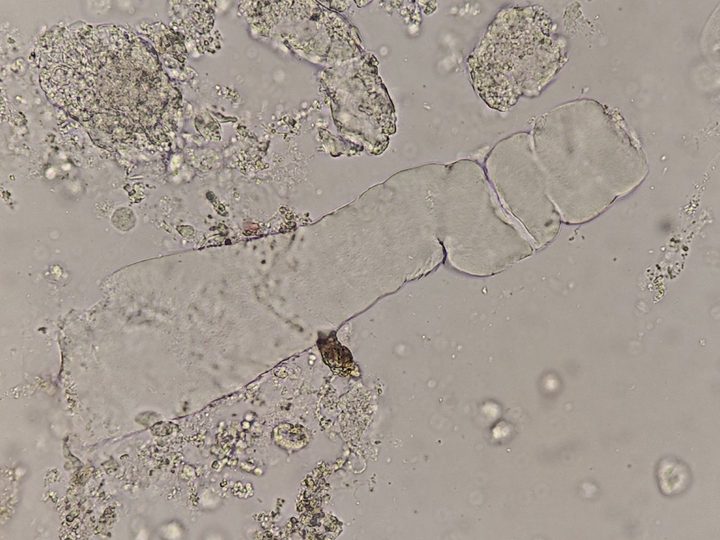Native urine preparation, wide waxy cast with deep transverse notches