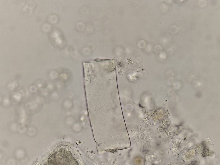 Native urine sediment preparation, fragment of a waxy cast with sharp edges