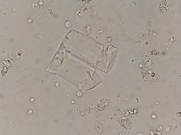 Native urine sediment preparation, wide short waxy cast with a fracture