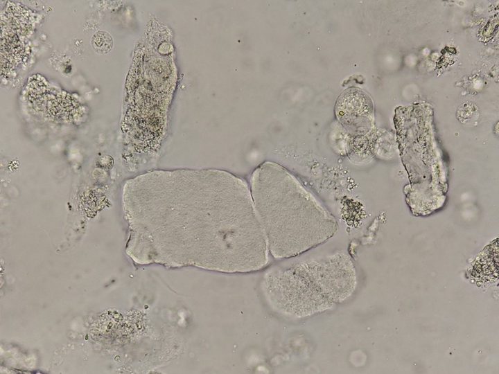 Native urine sediment preparation, fragments of wide waxy and granular casts