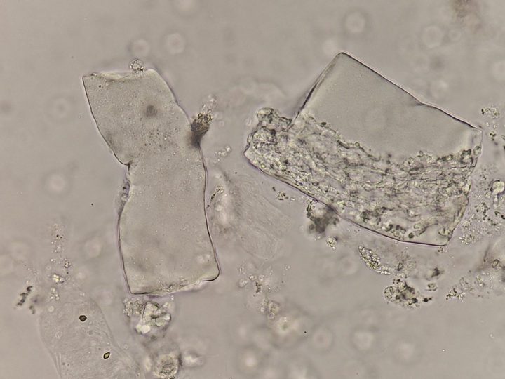 Native urine sediment preparation, waxy cast with a bay-like indentation on the edge