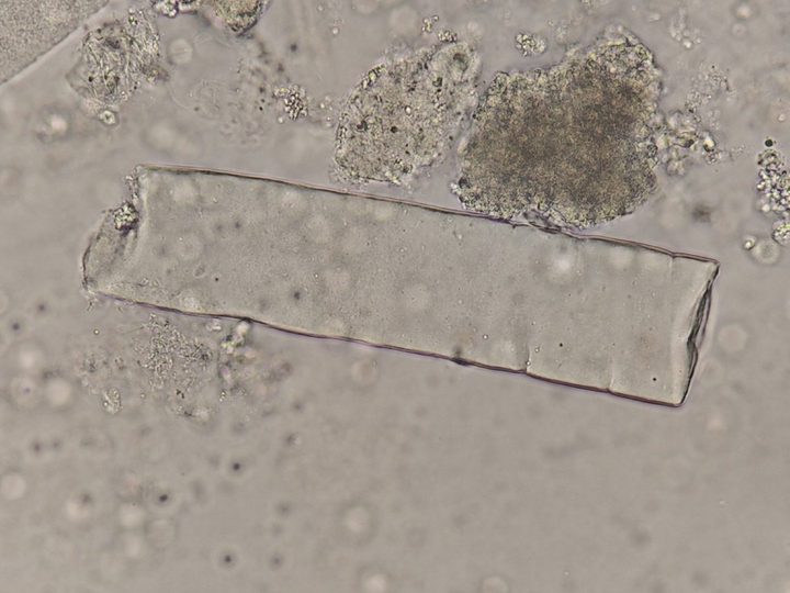 Native urine sediment preparation, large waxy cast with fine cracks