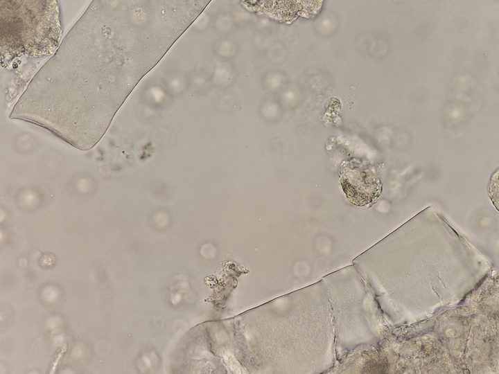 Native urine sediment preparation, waxy casts of high optical density