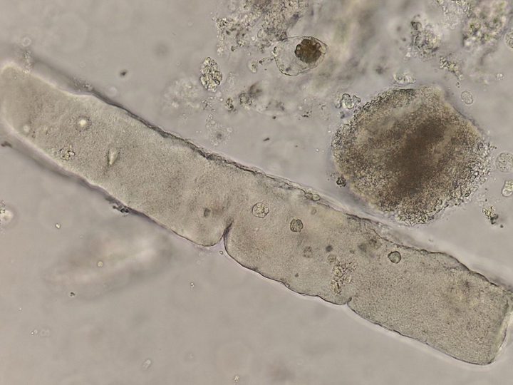 Native urine sediment preparation, long terminal waxy cast