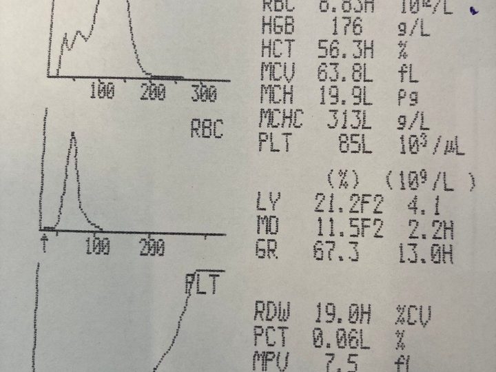 Распечатка анализатора: эритроцитоз RBC 8.83, лейкоцитоз и микроцитоз MCV 63.8