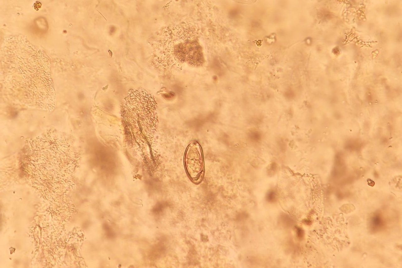 Opisthorchis Eggs in Bile: A Clinical Case Study