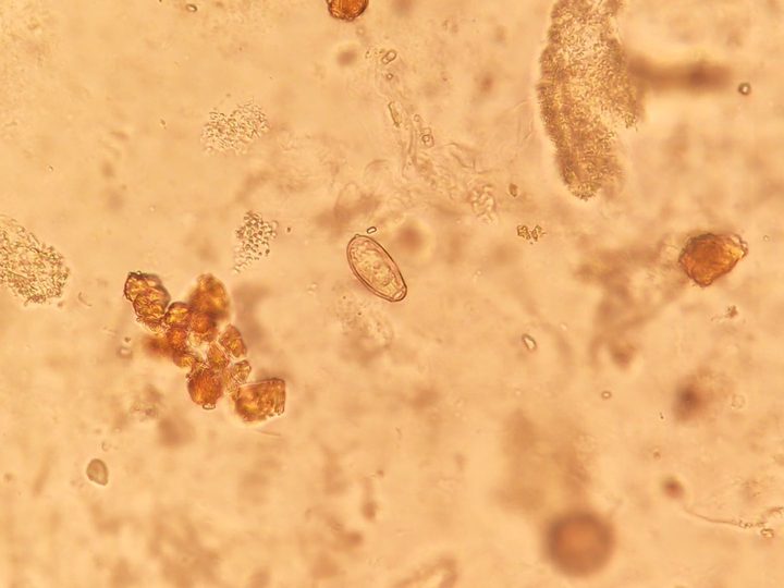 Opisthorchis egg and pigment inclusions in bile