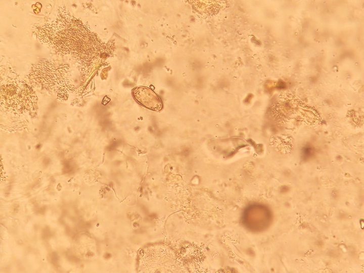 Opisthorchis egg among mucus and bile debris
