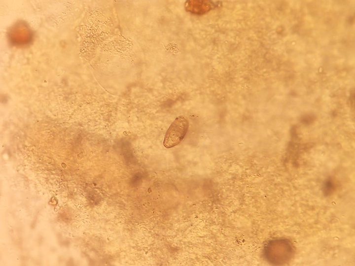 Opisthorchis egg in duodenal contents, another field