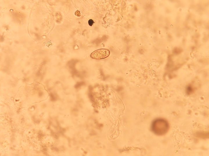Opisthorchis egg in a wet mount of bile