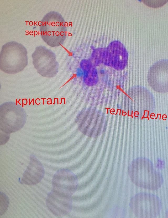 Зеленые кристаллы смерти в нейтрофилах при сепсисе