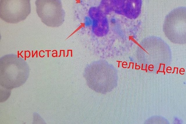Green Crystals of Death in Neutrophils During Sepsis