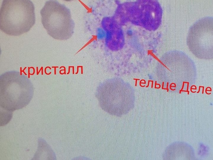Blood smear: neutrophil with toxic granulation, Döhle body, and green crystal