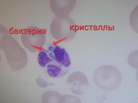 Blood smear: segmented neutrophil with phagocytosed bacterium and crystals