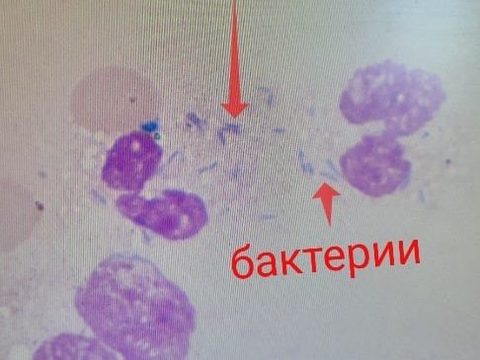 Blood smear: massive accumulation of rod-shaped bacteria around destroyed leukocytes