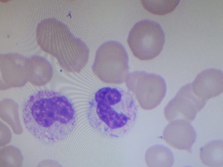 Blood smear: neutrophils with pronounced toxic granulation of the cytoplasm
