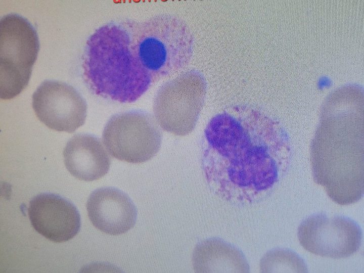Blood smear: phagocytosis of an apoptotic body by a neutrophil in the context of sepsis