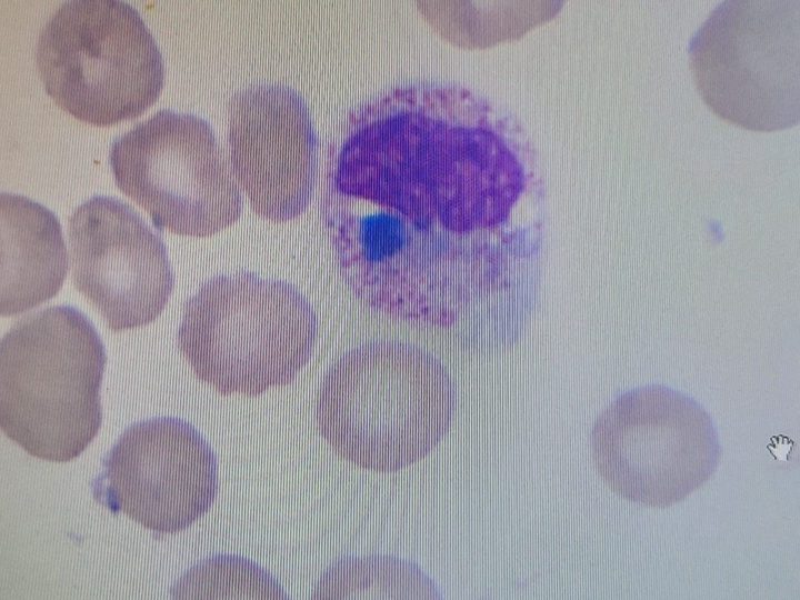 Blood smear: neutrophil with characteristic rounded blue-green lipofuscin inclusion