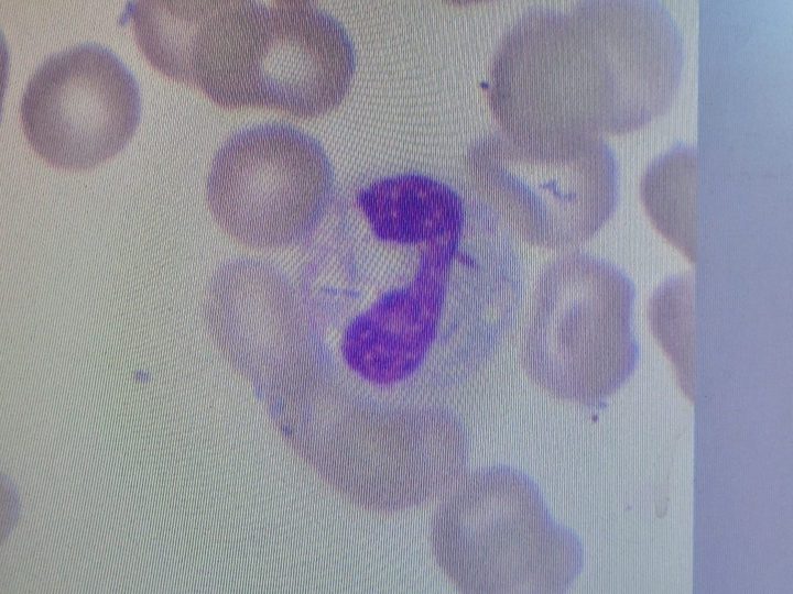 Blood smear: phagocytosed bacteria in the cytoplasm of a band neutrophil