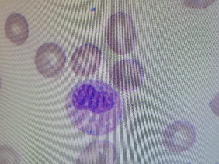 Blood smear: blue-green crystal and toxic granulation in neutrophil cytoplasm